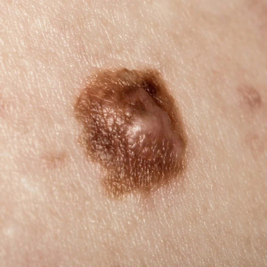cancer de la peau carcinome ou mélanome
